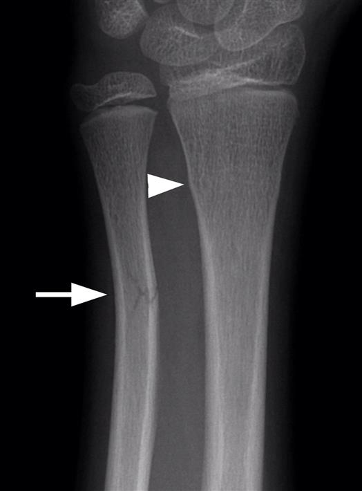 Greenstick Fractures Overview