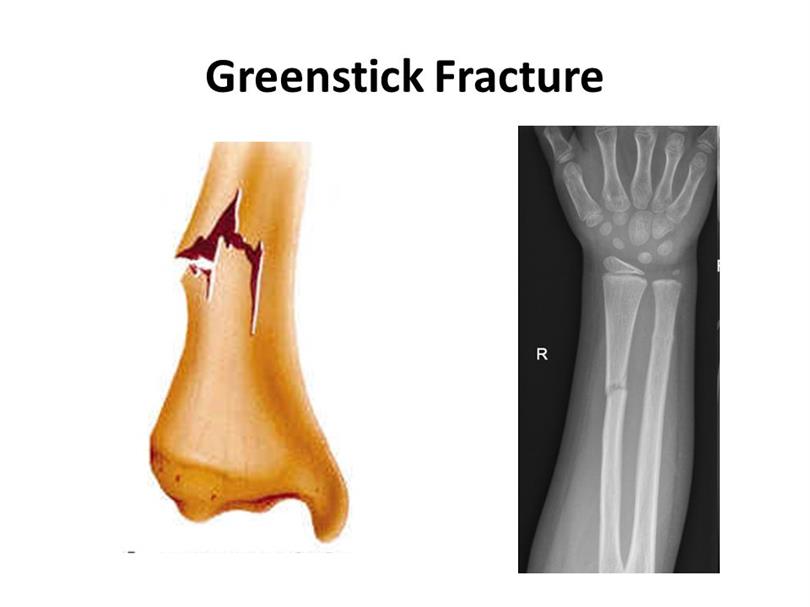 What is Greenstick Fracture?